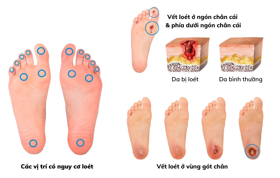 loét bàn chân đái tháo đường ở gót chân