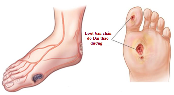 loét bàn chân do đái tháo đường