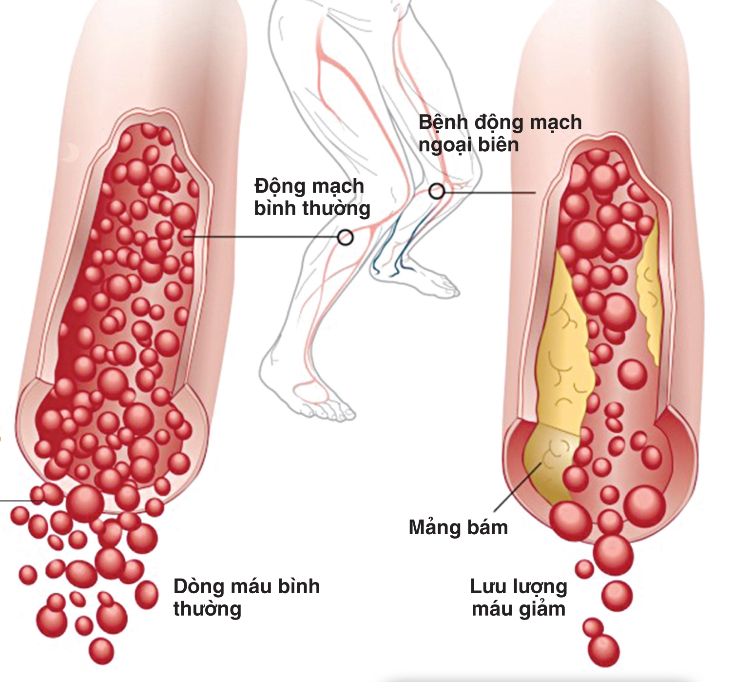 biến chứng động mạch ngoại biên đái tháo đường