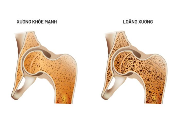 Biến chứng xương tiểu đường