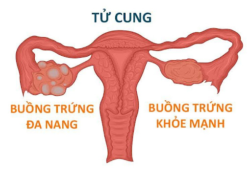 Hội chứng buồng trứng đa nang